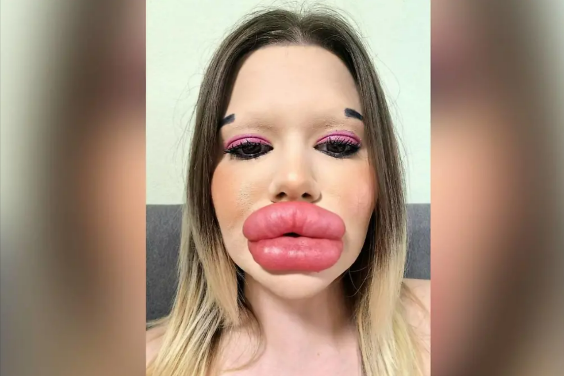 Diese Frau möchte die größten Lippen der Welt haben!