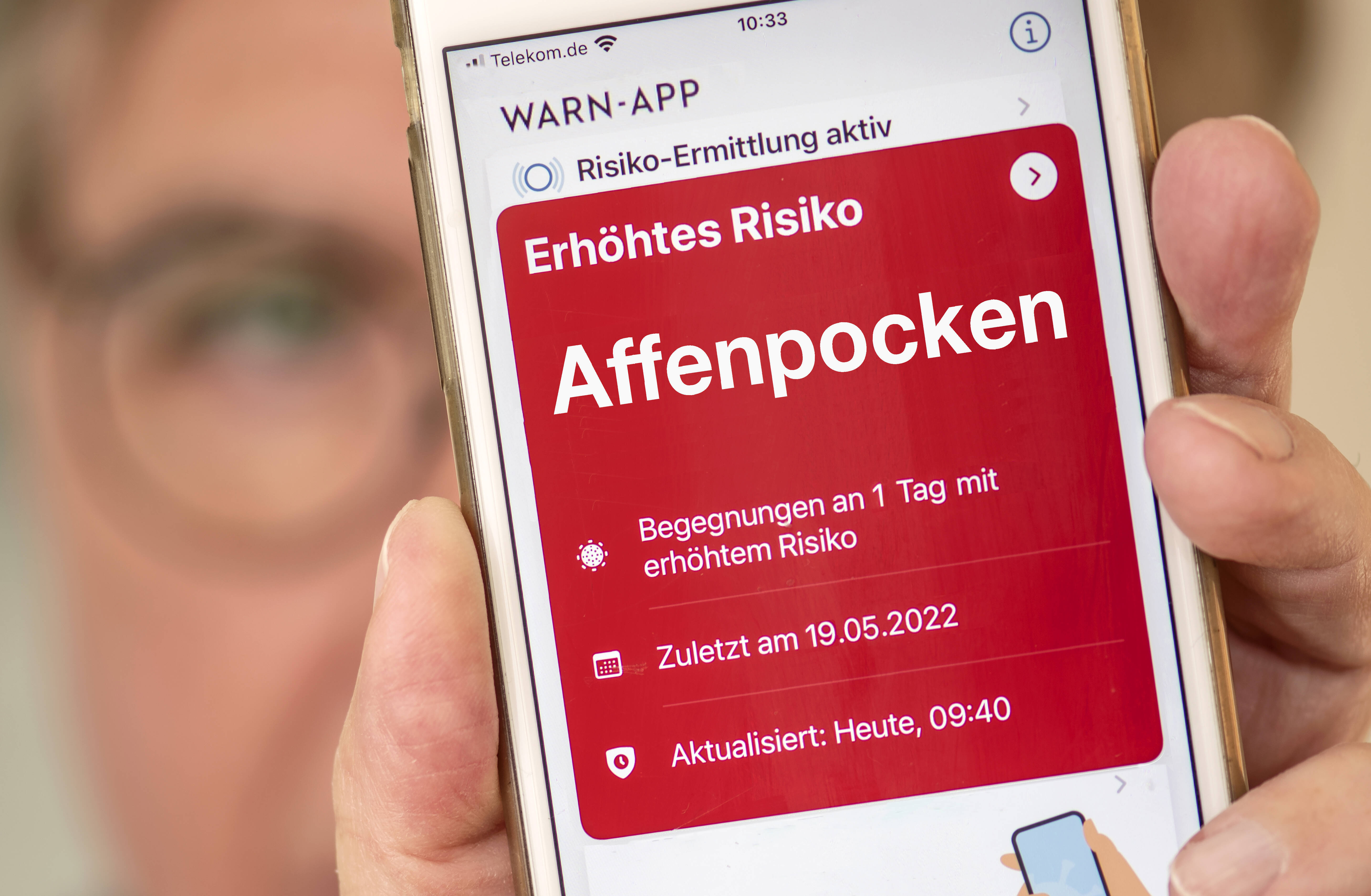 Affenpocken in Deutschland! 4-jähriges Mädchen infiziert! Neuer Seuchenausbruch in Deutschland