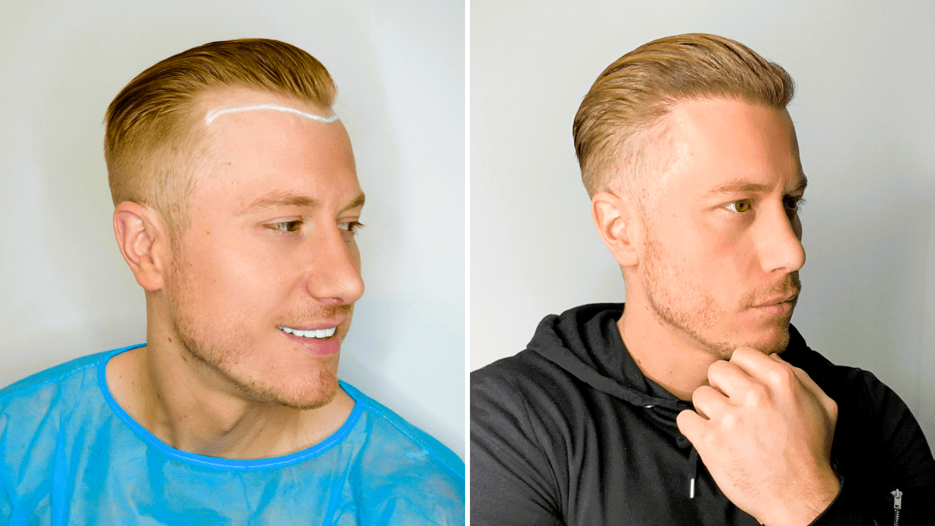 Il a ignoré la règle importante après une greffe de cheveux - et voici ce qui s'est passé !